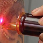 Laser Tattoo Removal in the UK: How It Works, Costs, Benefits & What to Expect
